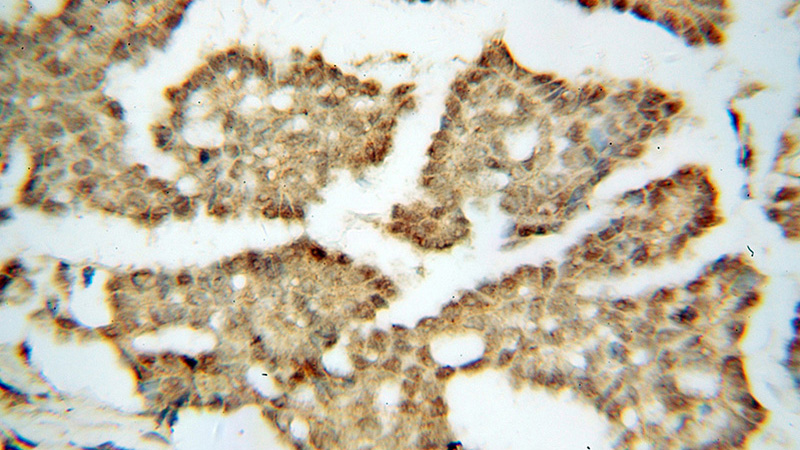 Immunohistochemical of paraffin-embedded human ovary tumor using Catalog No:109946(DIS3 antibody) at dilution of 1:100 (under 40x lens)