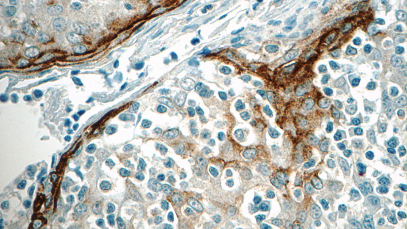 Immunohistochemistry of paraffin-embedded human tonsillitis tissue slide using Catalog No:112621(MIG6; ERRFI1 Antibody) at dilution of 1:50 (under 40x lens)