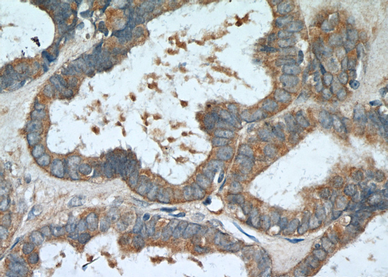 Immunohistochemistry of paraffin-embedded human ovary tumor tissue slide using Catalog No:113664(PDE5A Antibody) at dilution of 1:200 (under 40x lens).