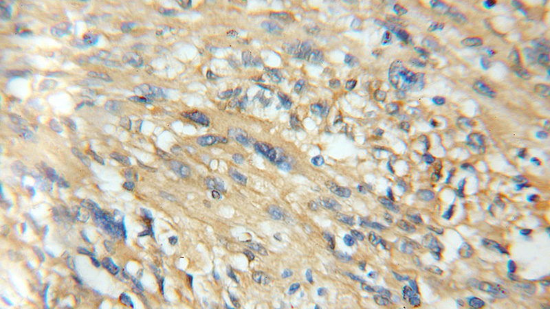 Immunohistochemical of paraffin-embedded human gliomas using Catalog No:108916(CAMK2B antibody) at dilution of 1:50 (under 10x lens)