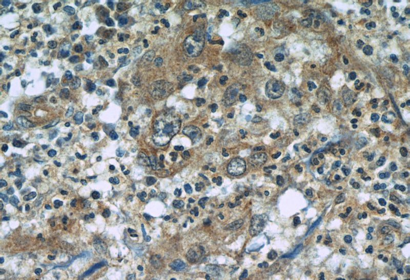 Immunohistochemistry of paraffin-embedded human cervical cancer tissue slide using Catalog No:107501(RBM4 Antibody) at dilution of 1:50 (under 40x lens)
