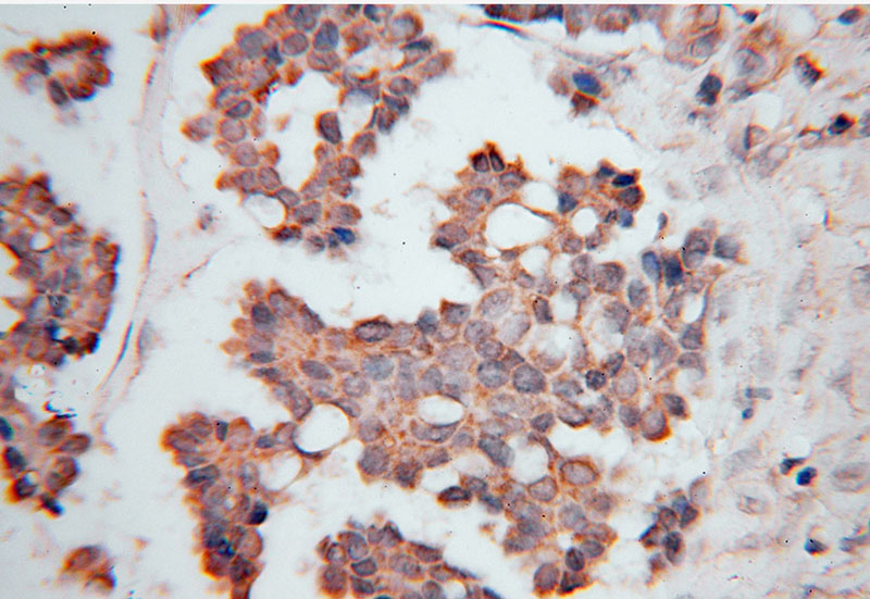 Immunohistochemical of paraffin-embedded human ovary tumor using Catalog No:116716(VARS2 antibody) at dilution of 1:100 (under 40x lens)