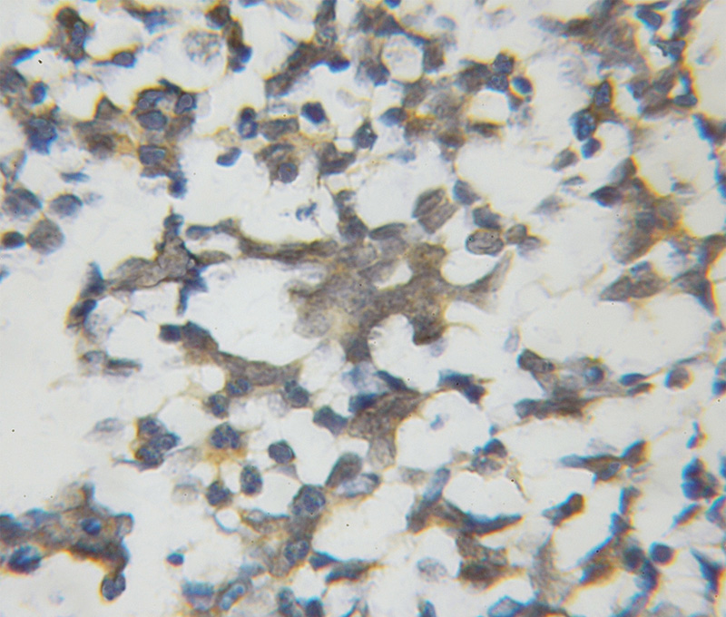 Immunohistochemical of paraffin-embedded human gliomas using Catalog No:111819(IPO13 antibody) at dilution of 1:50 (under 10x lens)