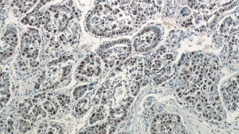 Immunohistochemistry of paraffin-embedded human liver cancer tissue slide using Catalog No:115165(CCDC101 Antibody) at dilution of 1:400 (under 10x lens)
