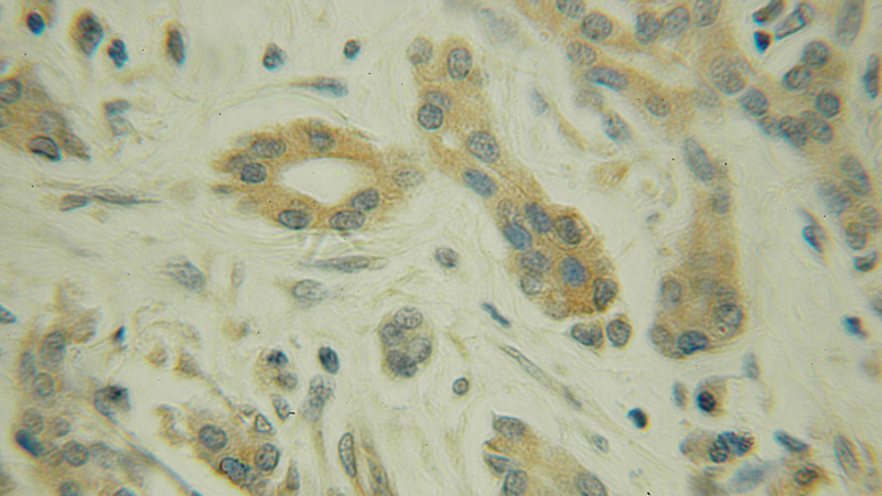 Immunohistochemical of paraffin-embedded human pancreas cancer using Catalog No:115168(SGK3 antibody) at dilution of 1:100 (under 10x lens)