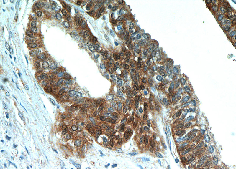 Immunohistochemical of paraffin-embedded human prostate hyperplasia using Catalog No:107812(ABHD14B antibody) at dilution of 1:50 (under 40x lens)
