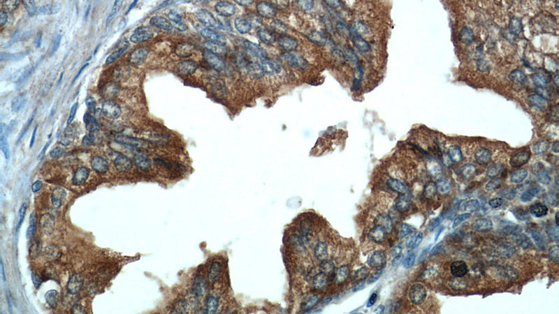 Immunohistochemical of paraffin-embedded human prostate hyperplasia using Catalog No:113323(ODC1 antibody) at dilution of 1:50 (under 40x lens)