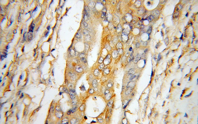 Immunohistochemical of paraffin-embedded human colon cancer using Catalog No:116546(UCP2 antibody) at dilution of 1:50 (under 40x lens)
