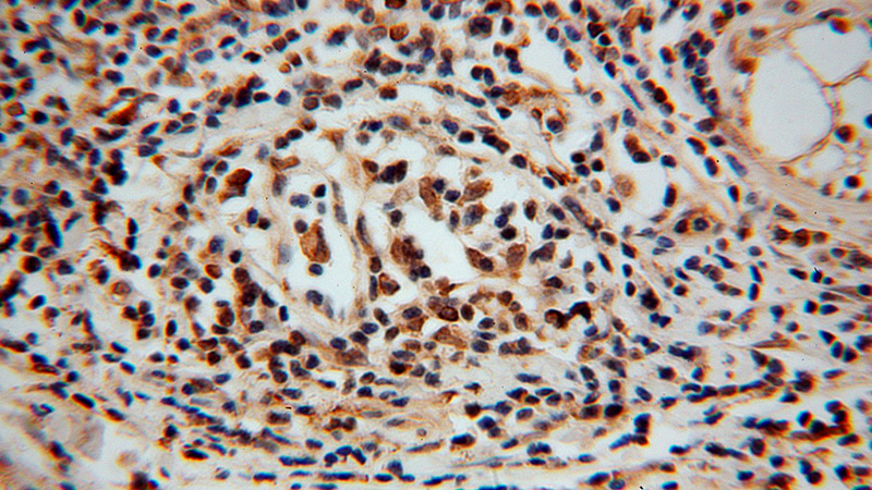 Immunohistochemical of paraffin-embedded human ovary tumor using Catalog No:113003(MYST2 antibody) at dilution of 1:50 (under 40x lens)
