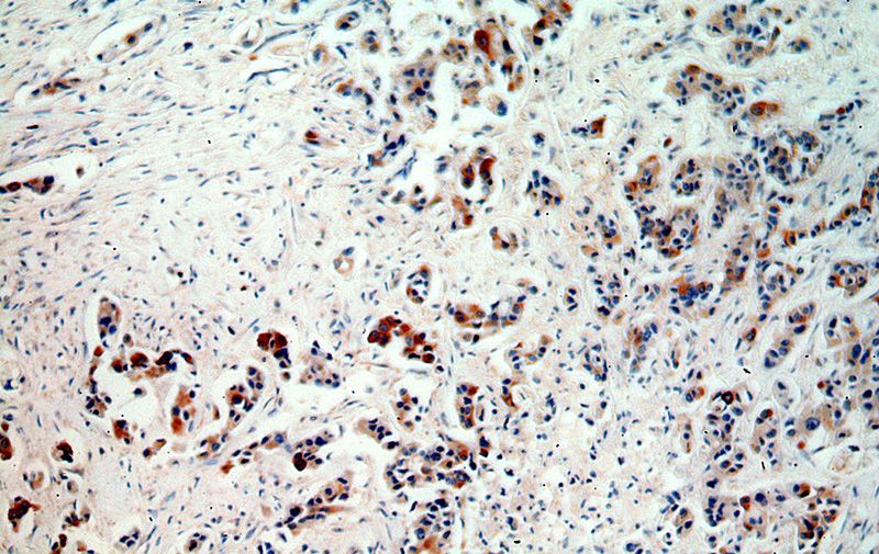 Immunohistochemical of paraffin-embedded human breast cancer using Catalog No:110636(FGF8 antibody) at dilution of 1:50 (under 10x lens)