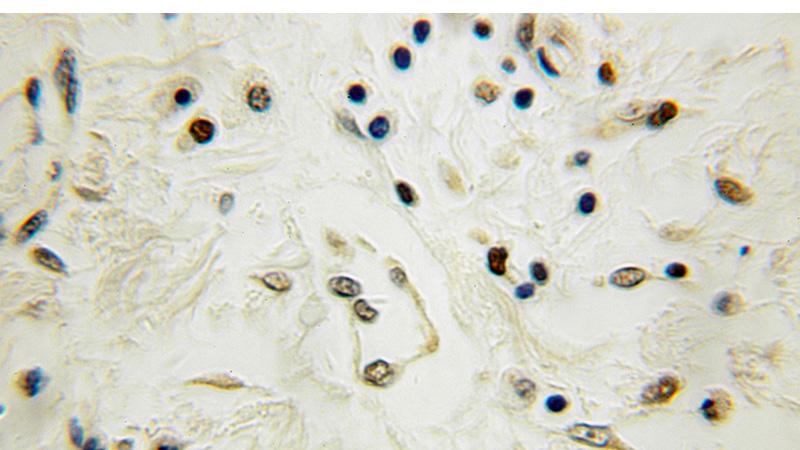 Immunohistochemical of paraffin-embedded human breast cancer using Catalog No:109740(CUGBP2 antibody) at dilution of 1:100 (under 10x lens)