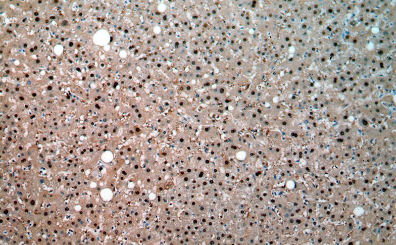 Immunohistochemical of paraffin-embedded human liver using Catalog No:111179(GSTA1 antibody) at dilution of 1:50 (under 10x lens)
