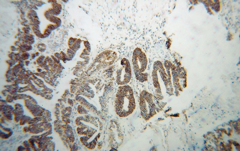 Immunohistochemical of paraffin-embedded human liver cancer using Catalog No:111184(GSTK1 antibody) at dilution of 1:100 (under 10x lens)