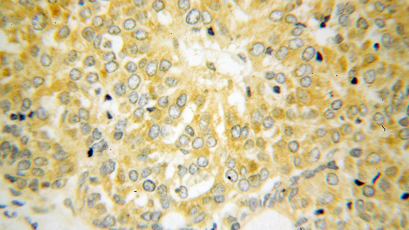 Immunohistochemical of paraffin-embedded human liver cancer using Catalog No:114895(RPL39 antibody) at dilution of 1:100 (under 40x lens)