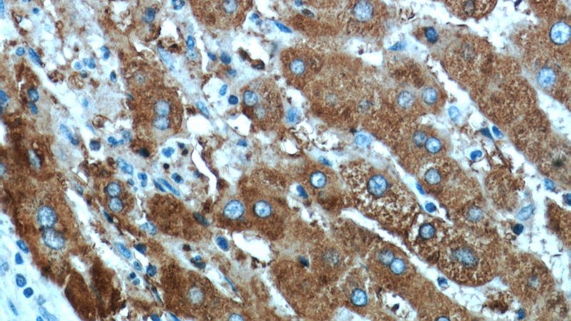 Immunohistochemical of paraffin-embedded human liver cancer using Catalog No:116397(TRMT2B antibody) at dilution of 1:50 (under 40x lens)