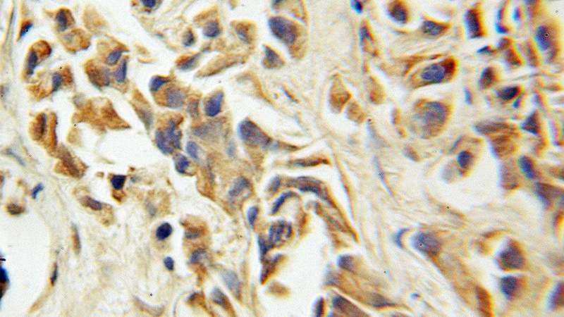 Immunohistochemical of paraffin-embedded human prostate cancer using Catalog No:117310(COXIV antibody) at dilution of 1:100 (under 10x lens)