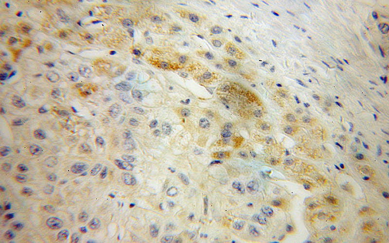 Immunohistochemical of paraffin-embedded human liver cancer using Catalog No:107671(AADAT antibody) at dilution of 1:50 (under 25x lens)