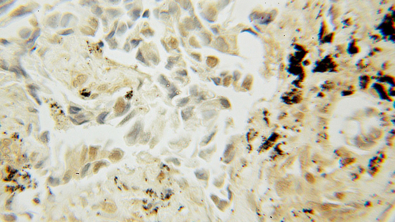 Immunohistochemical of paraffin-embedded human lung cancer using Catalog No:116508(UBC9 antibody) at dilution of 1:50 (under 10x lens)