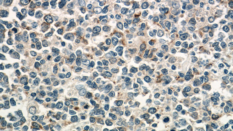 Immunohistochemistry of paraffin-embedded human tonsillitis tissue slide using Catalog No:109638(CXCL13 Antibody) at dilution of 1:50 (under 40x lens)