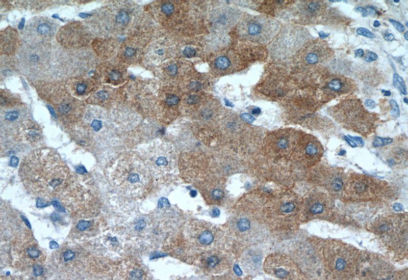 Immunohistochemistry of paraffin-embedded human hepatocirrhosis tissue slide using Catalog No:111358(hIST1 Antibody) at dilution of 1:50 (under 40x lens)
