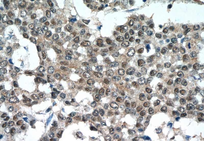 Immunohistochemistry of paraffin-embedded human colon cancer tissue slide using Catalog No:113098(NEDD8 Antibody) at dilution of 1:50 (under 40x lens)