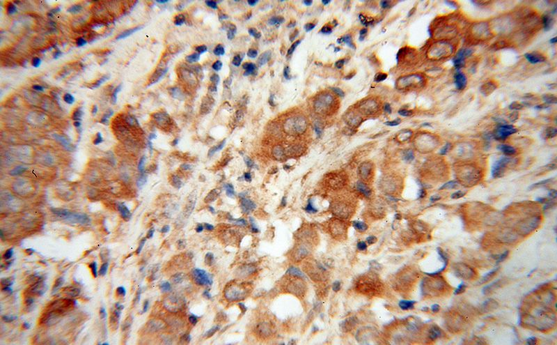 Immunohistochemical of paraffin-embedded human prostate cancer using Catalog No:113084(NDUFS6 antibody) at dilution of 1:100 (under 40x lens)