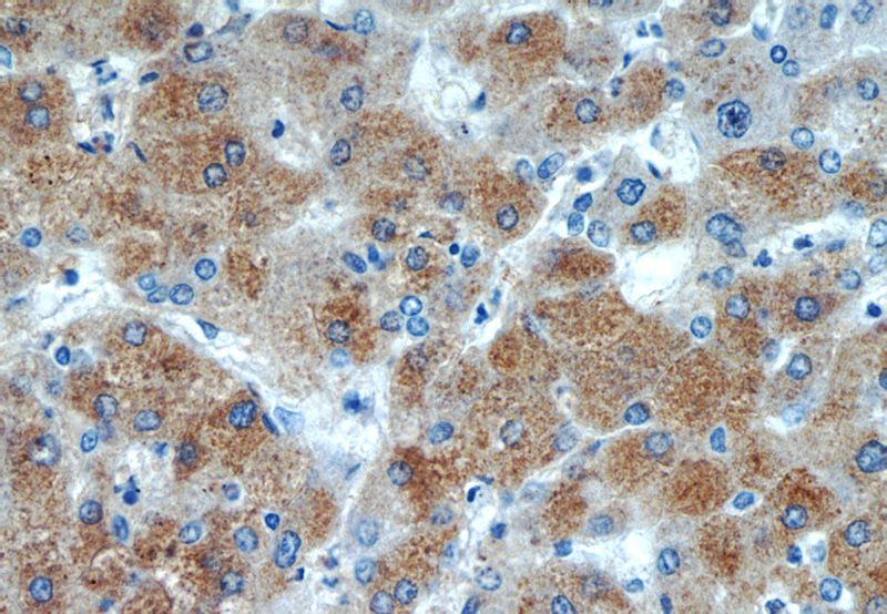 Immunohistochemistry of paraffin-embedded human hepatocirrhosis tissue slide using Catalog No:108400(BAAT Antibody) at dilution of 1:100 (under 40x lens)