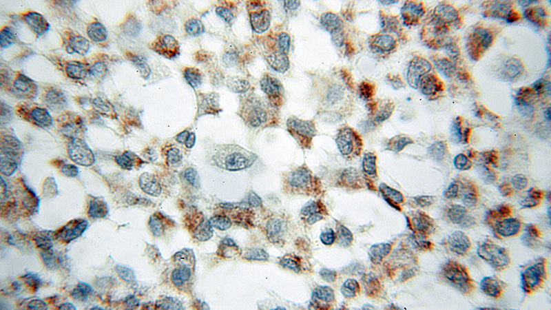 Immunohistochemical of paraffin-embedded human breast cancer using Catalog No:115159(SFXN1 antibody) at dilution of 1:50 (under 10x lens)
