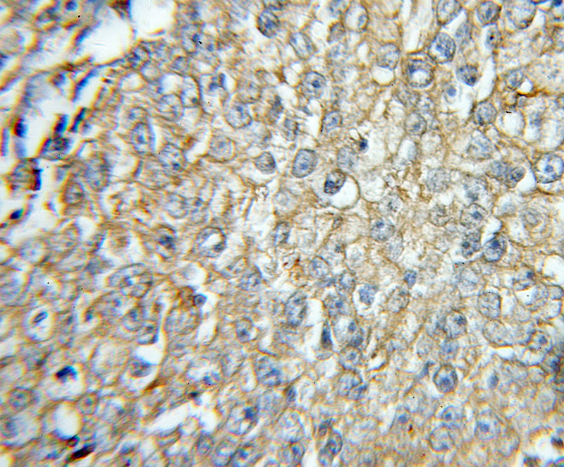 Immunohistochemical of paraffin-embedded human lung cancer using Catalog No:115895(TBXAS1 antibody) at dilution of 1:50 (under 10x lens)