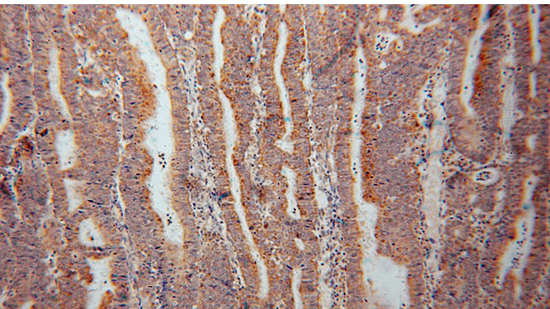 Immunohistochemical of paraffin-embedded human endometrial cancer using Catalog No:116459(TXNRD2 antibody) at dilution of 1:50 (under 10x lens)