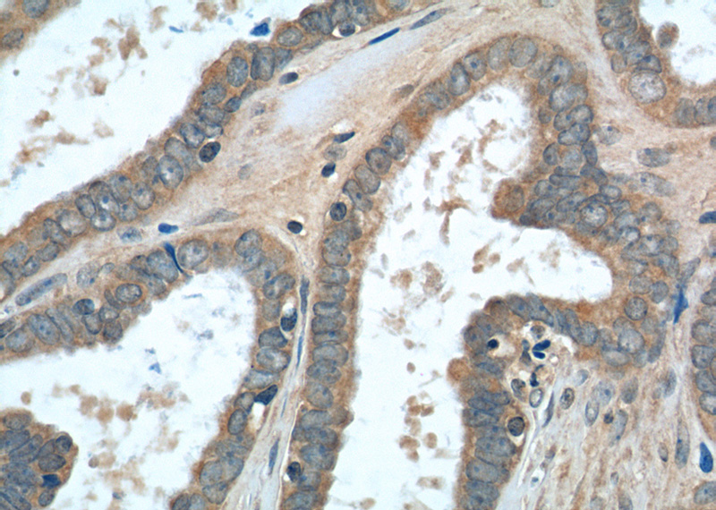 Immunohistochemistry of paraffin-embedded human ovary tumor tissue slide using Catalog No:116197(TMEM77 Antibody) at dilution of 1:50 (under 40x lens)