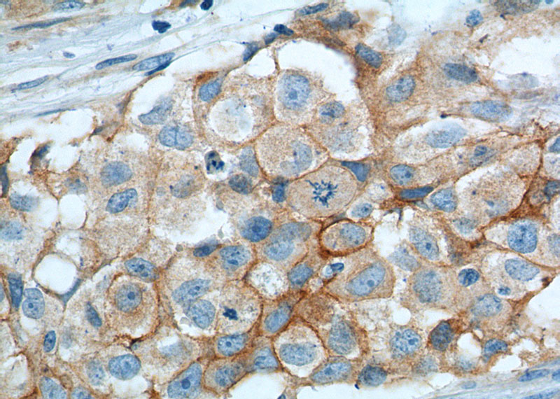 Immunohistochemistry of paraffin-embedded human lung cancer tissue slide using (VCAM-1 Antibody) at dilution of 1:800 (under 40x lens). heat mediated antigen retrieved with Tris-EDTA buffer(pH9).