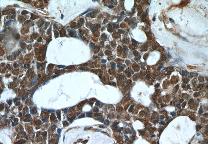 Immunohistochemistry of paraffin-embedded human cervical cancer tissue slide using Catalog No:113811(PHF2 Antibody) at dilution of 1:50 (under 40x lens)