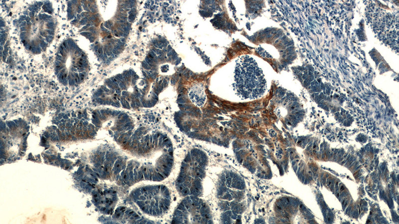 Immunohistochemistry of paraffin-embedded human colon cancer slide using Catalog No:116201(TMEM9B Antibody) at dilution of 1:50