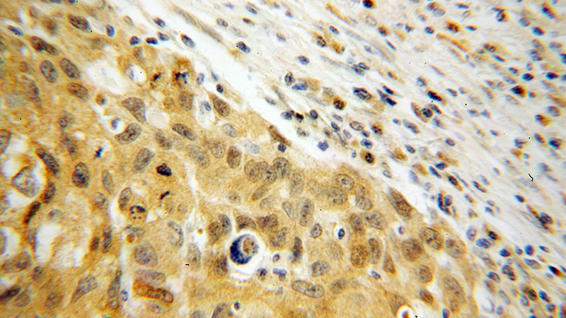 Immunohistochemical of paraffin-embedded human lung cancer using Catalog No:113246(NME1 antibody) at dilution of 1:100 (under 40x lens)
