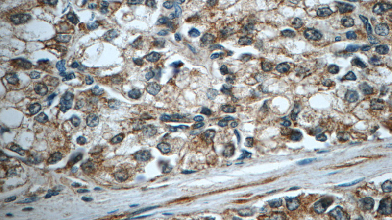 Immunohistochemistry of paraffin-embedded human prostate cancer tissue slide using Catalog No:108698(C20orf195 Antibody) at dilution of 1:50 (under 40x lens)