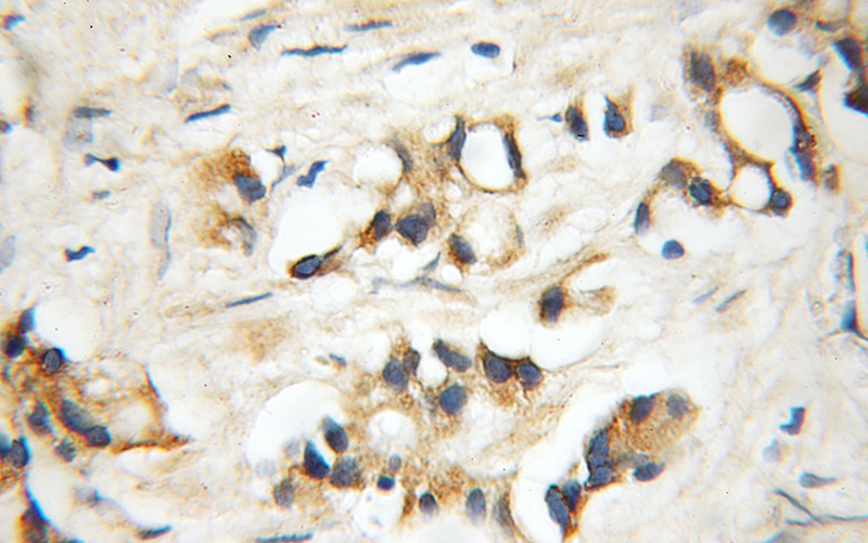 Immunohistochemical of paraffin-embedded human prostate cancer using Catalog No:109826(DDX28 antibody) at dilution of 1:50 (under 10x lens)