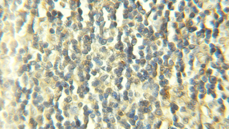 Immunohistochemical of paraffin-embedded human lymphoma using Catalog No:109500(COX7B antibody) at dilution of 1:100 (under 10x lens)