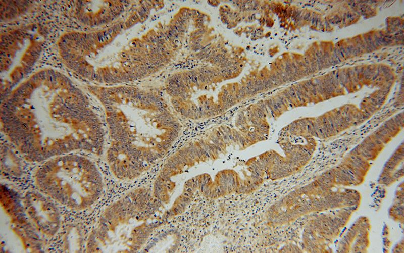 Immunohistochemical of paraffin-embedded human colon cancer using Catalog No:115027(SDCCAG3 antibody) at dilution of 1:50 (under 10x lens)