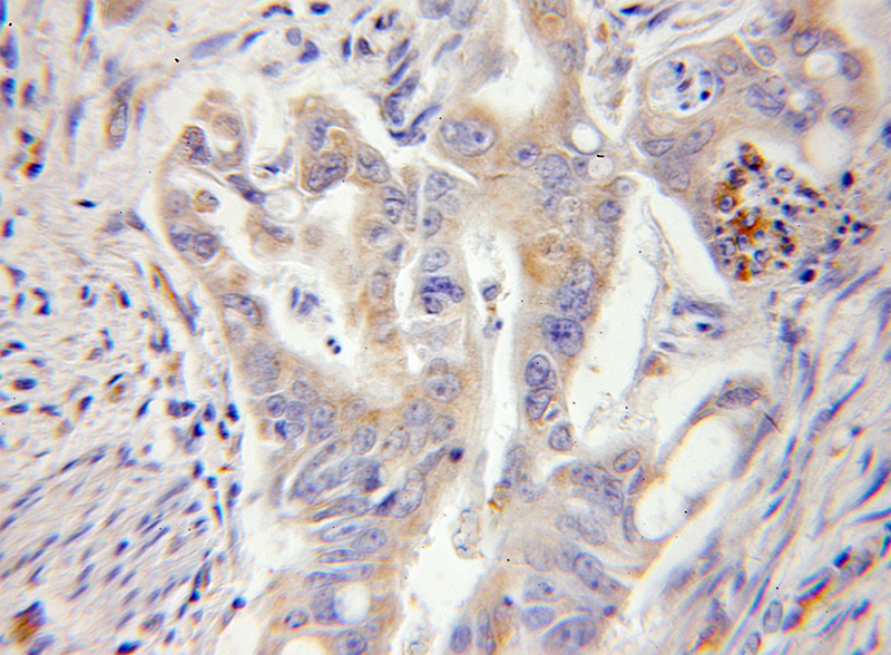 Immunohistochemical of paraffin-embedded human colon cancer using Catalog No:114813(RPL13 antibody) at dilution of 1:50 (under 10x lens)