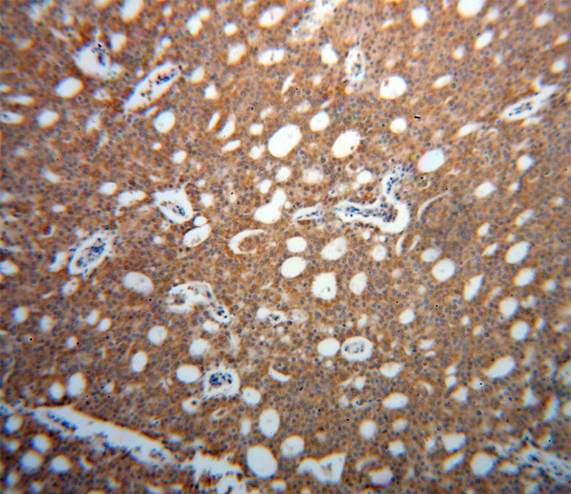 Immunohistochemical of paraffin-embedded human prostate cancer using Catalog No:110780(FSCN3 antibody) at dilution of 1:50 (under 10x lens)
