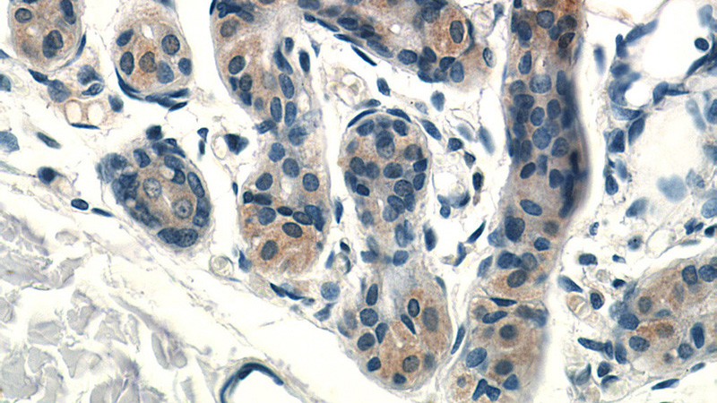 Immunohistochemistry of paraffin-embedded human skin tissue slide using Catalog No:115645(SPRR2F Antibody) at dilution of 1:50 (under 40x lens)
