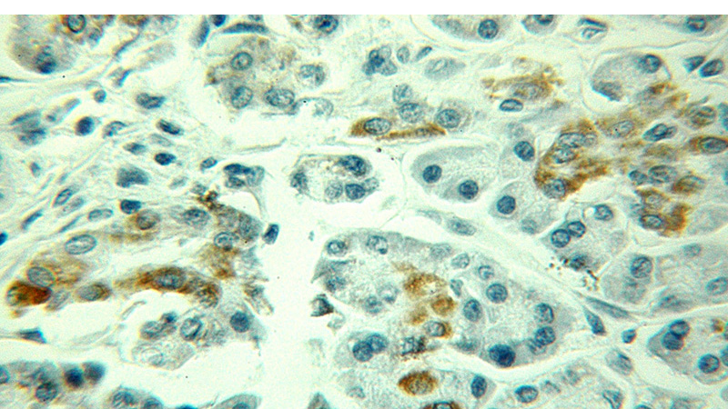 Immunohistochemical of paraffin-embedded human pancreas cancer using Catalog No:112469(MAOA antibody) at dilution of 1:100 (under 25x lens)