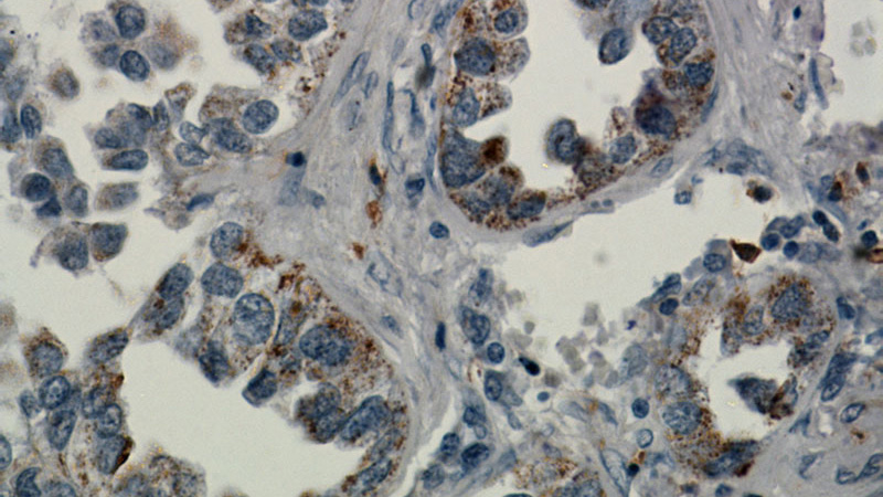 Immunohistochemical of paraffin-embedded human lung cancer using Catalog No:110467(FAM124B antibody) at dilution of 1:50 (under 40x lens). Heat mediated antigen retrieved with Citric acid buffer, pH6.0.
