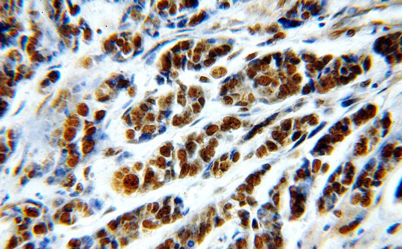 Immunohistochemical of paraffin-embedded human cervical cancer using Catalog No:114588(RBBP7 antibody) at dilution of 1:50 (under 40x lens)