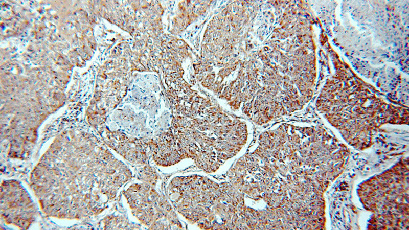 Immunohistochemical of paraffin-embedded human lung cancer using Catalog No:112126(KRT10-specific antibody) at dilution of 1:200 (under 10x lens)