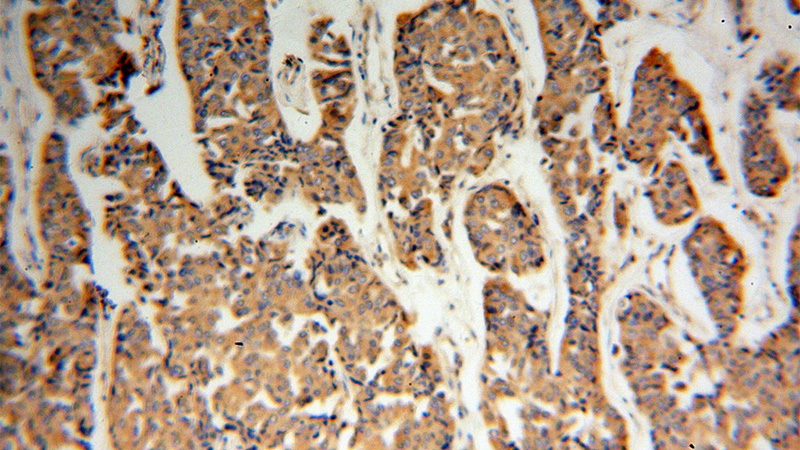 Immunohistochemical of paraffin-embedded human breast cancer using Catalog No:108832(CANX antibody) at dilution of 1:100 (under 10x lens)