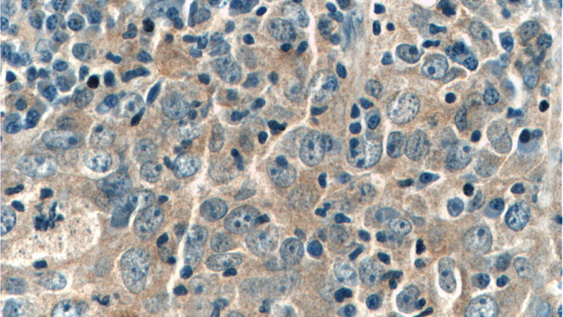 Immunohistochemistry of paraffin-embedded human breast cancer tissue slide using Catalog No:108061(ANKLE1 Antibody) at dilution of 1:50 (under 40x lens)