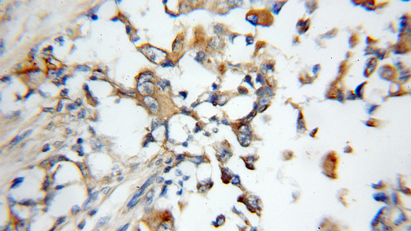 Immunohistochemical of paraffin-embedded human breast cancer using Catalog No:108208(ARSD antibody) at dilution of 1:50 (under 10x lens)