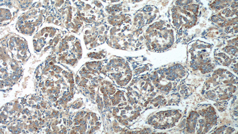 Immunohistochemistry of paraffin-embedded human liver cancer tissue slide using Catalog No:114422(RAB23 Antibody) at dilution of 1:200 (under 10x lens).